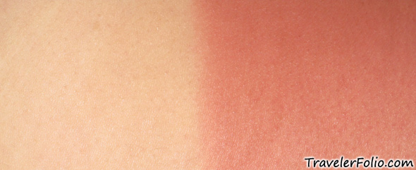 sun-burnt-skin